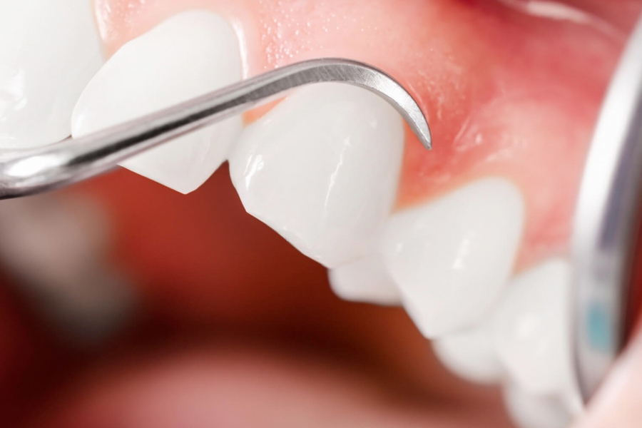 Diş Eti Tedavileri (Periodontoloji) Eskicioğlu Diş